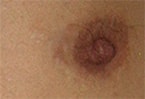 Extended Keyhole FtM Mastectomy scars