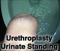 FtM Urethroplasty: urinate standing