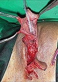FtM Neo-urethra creation