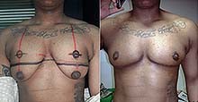 Mastectomy