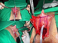 FtM Metoidioplasty
