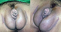 Female to Male Metoidioplasty