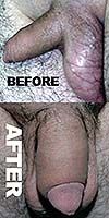 Penis enhancement, penis enlargement surgery by Dr Kim Jin Hong