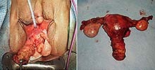 Trans-vaginal hysterectomy and simultaneous bilateral salpingo-oopherectomy