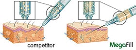 Micronization of injectable phalloplasty material aims to improve aesthetics