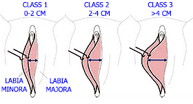 Labiaplasty classes
