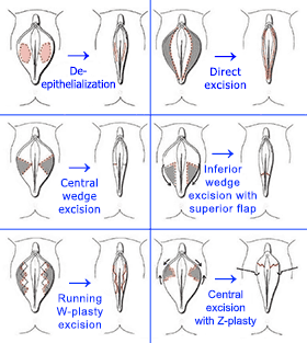 Labiaplasty