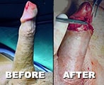 Penis enlargement by PLGA and surgery