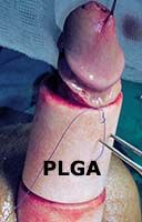 Penile girth enhancement using PLGA scaffolds for the tissue engineering