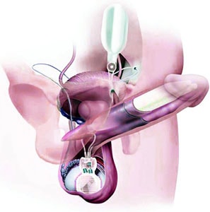 Coloplast Titan penile prosthesis
